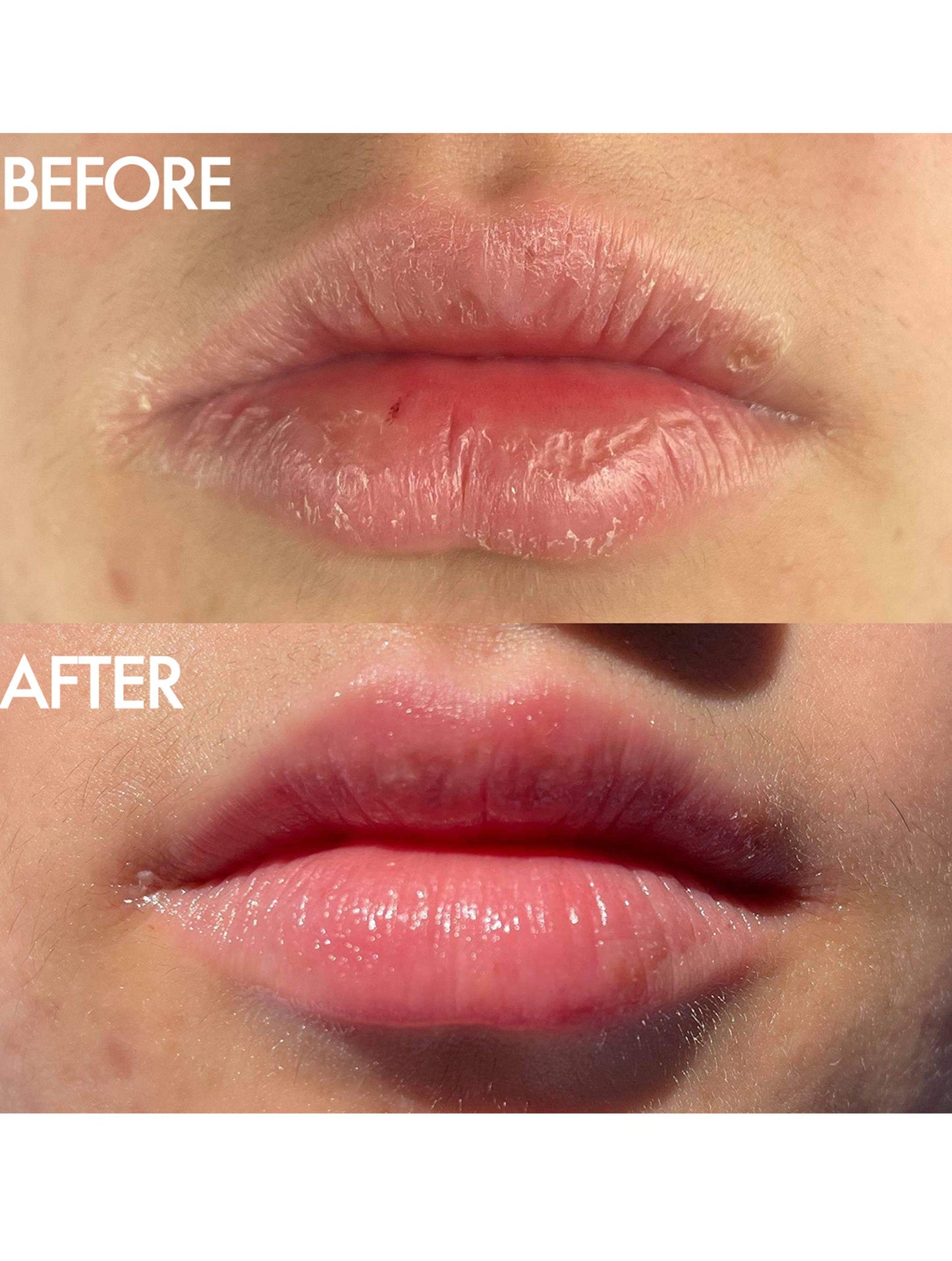Before and after close up of lips showing the visible transformation after using Lanolips 101 Ointment. The top image shows dry, cracked lips, while the bottom reveals hydrated, smooth, and glossy lips. Demonstrates the balm’s effectiveness in deeply nourishing and restoring lip moisture.