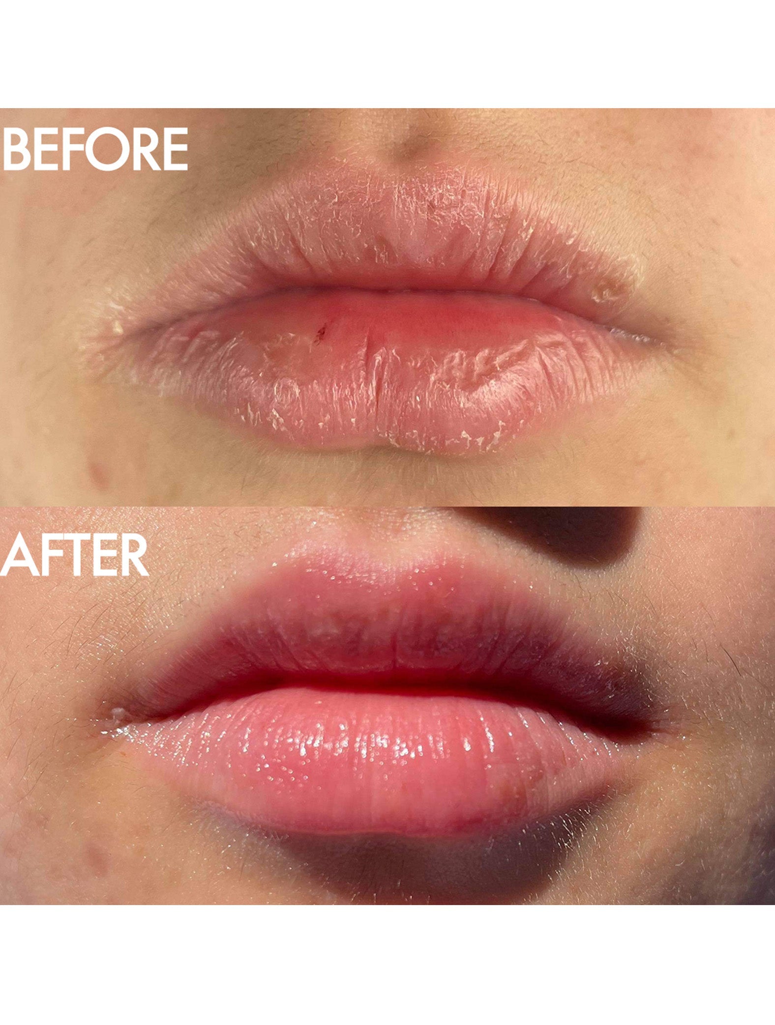 Before and after close up of lips showing the visible transformation after using Lanolips 101 Ointment. The top image shows dry, cracked lips, while the bottom reveals hydrated, smooth, and glossy lips. Demonstrates the balm’s effectiveness in deeply nourishing and restoring lip moisture.
