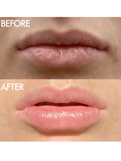 Before and after shot of Lanolips The Original 101 Ointment Multipurpose Superbalm. Top image shows dry, cracked lips; bottom image shows smooth, hydrated lips after using ultra-pure grade lanolin. Delivers intense hydration for lips, skin patches, cuticles, elbows and more. Safe for pregnancy, nursing mothers, and babies.