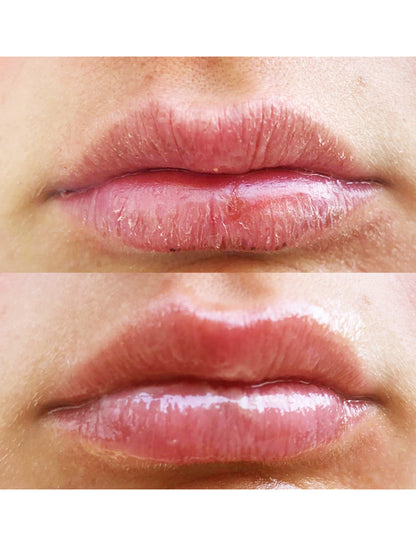 Before and after image showing dramatic improvement in dry, chapped lips after using Lanolips 101 Ointment. Known as The World's Best Lip Balm - voted by Reddit & The Times UK - this 100% natural, multi-award-winning balm uses ultra-pure Aussie lanolin to hydrate, soothe and protect. Safe for newborns.