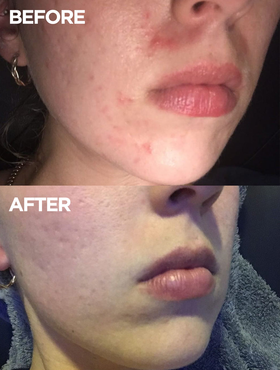 Before and after images showing visible improvement in skin texture and hydration after using Lanolips Face Base Day Cream with Lanolin and Vitamin E – redness and dryness reduced, skin appears smoother and more nourished.